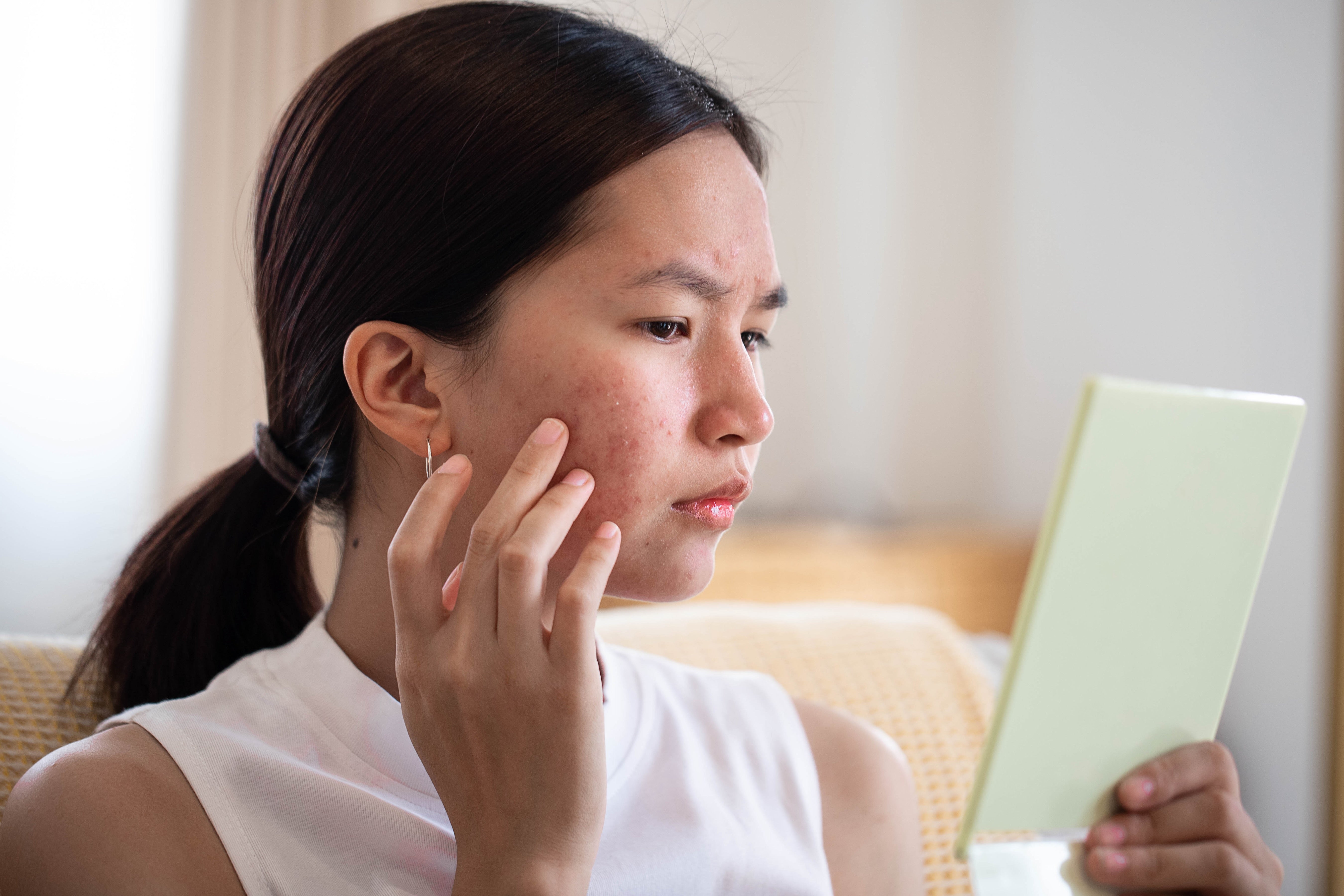 Can Colostrum Help Treat Acne?